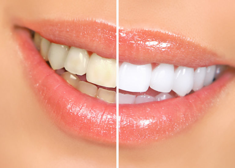 Tanden bleken in huis - Zonder peroxide - Wittere tanden makkelijk - Luxury White